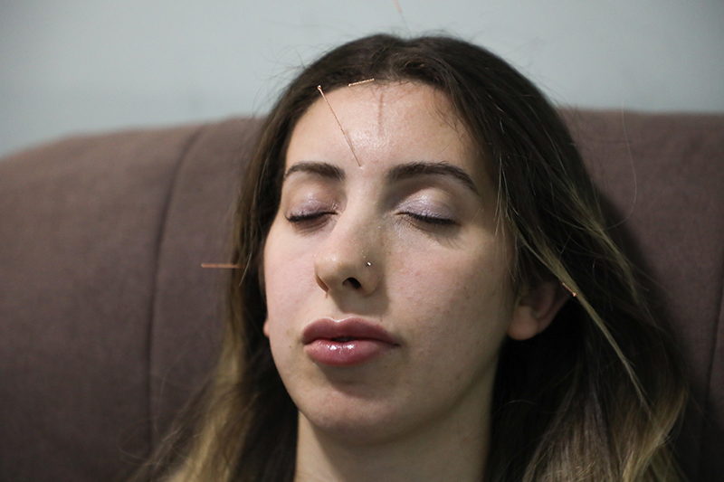 acupuntura